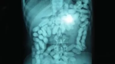 Cocaine Pellets in Stomach